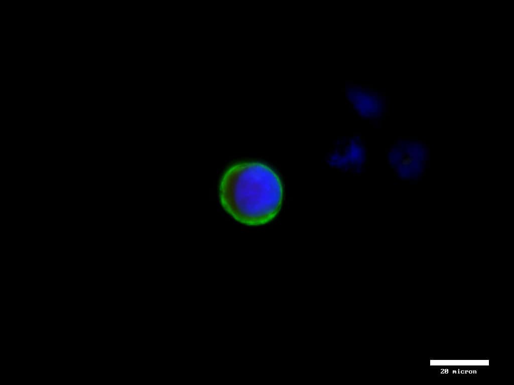 CK + CTC from breast cancer patient (40x)