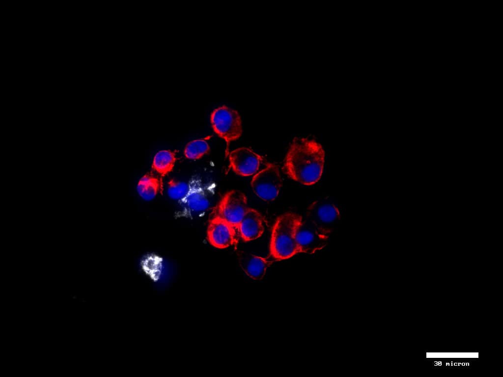 Cluster of mesenchymal CTCs (red) from breast cancer patient (20x)