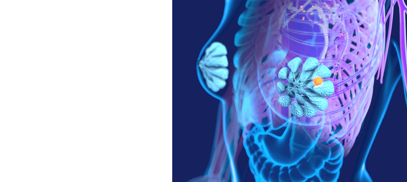 Graphic image of breast cancer