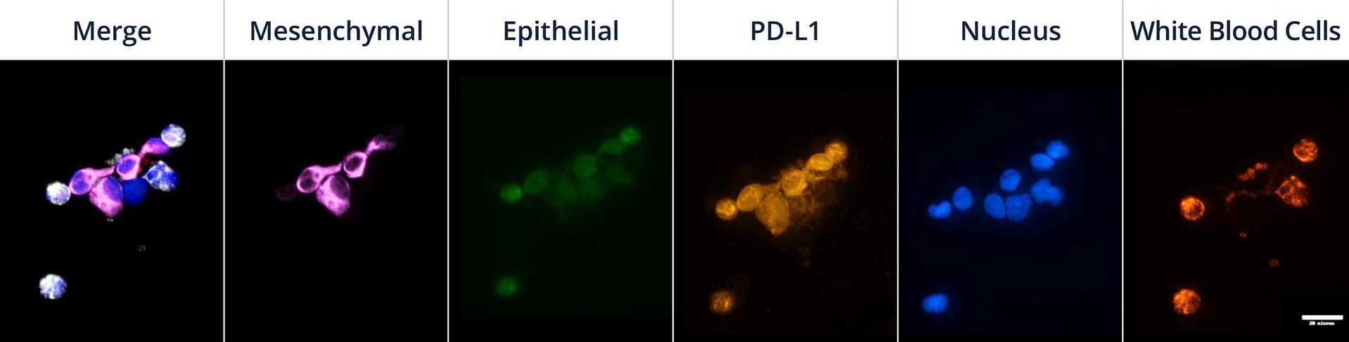 Representative staining of a CTC cluster from a lung cancer patient