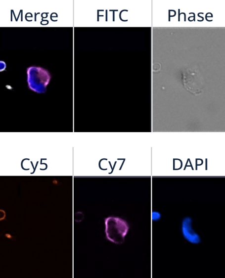 Epithelial and Mesenchymal CTC Detection in Triple Negative Breast Cancer Patients using ANGLE’s Parsortix® System
