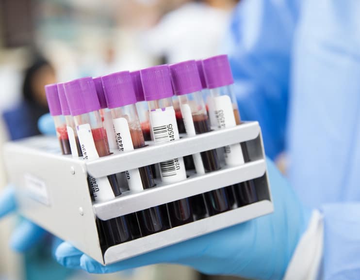 Blood sample collection tubes in a rack