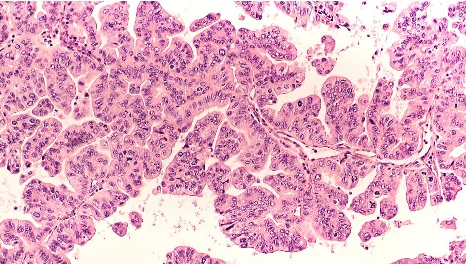 Image of ovarian cancer cells