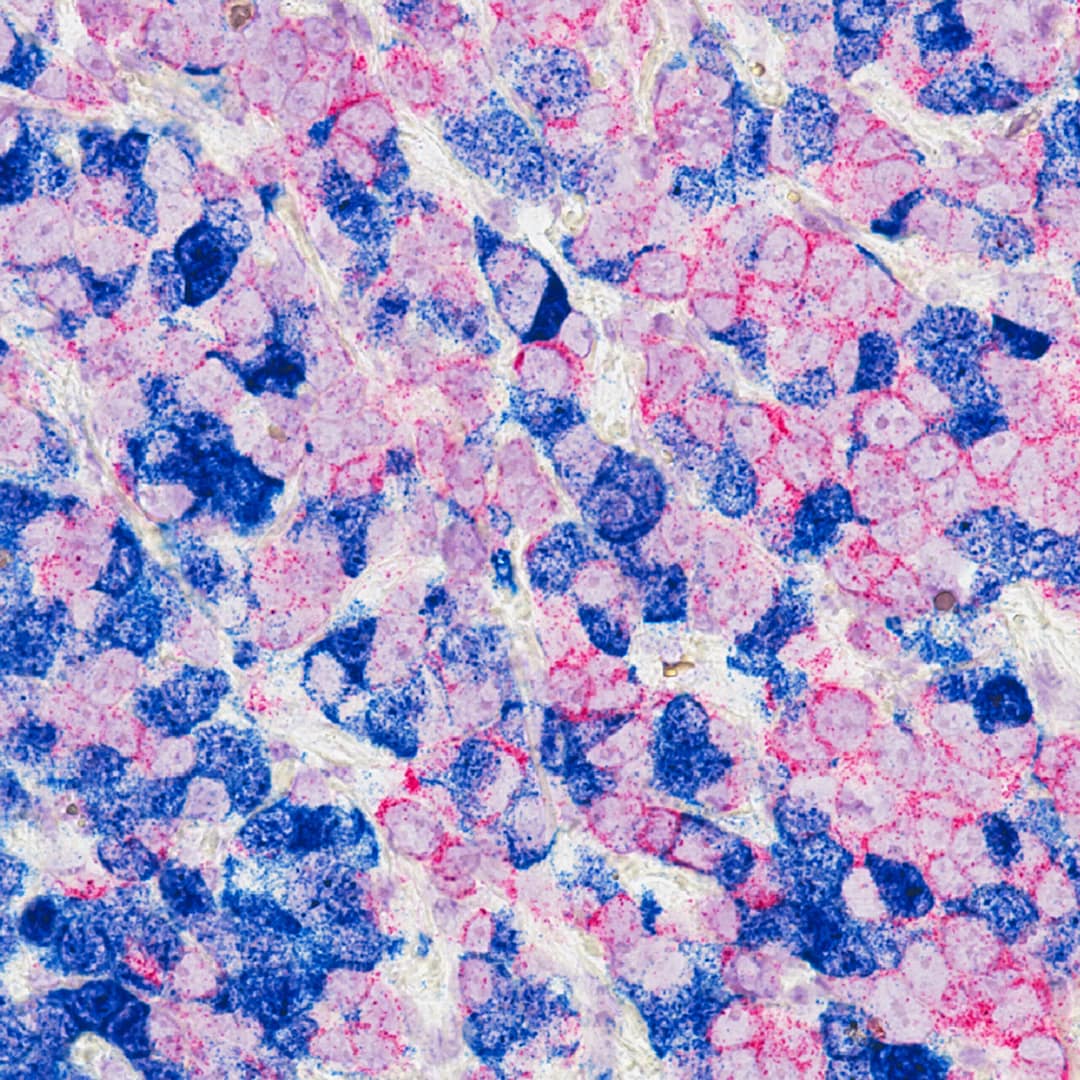 Breast Cancer Cells Capture- National cancer institute